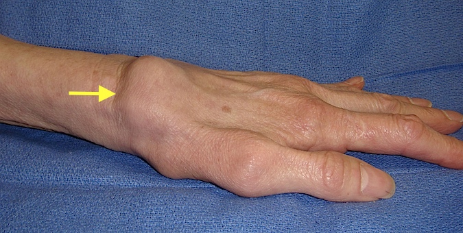 SLAC Wrist lateral view with dorsal radial Synovitis (see arrow)