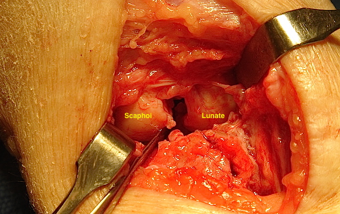 SLAC Wrist with gap between Scaphoid and Lunate secondary to chronic S-L ligament rupture