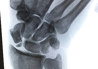 Scaphoid nonunion with early arthritis at radioscaphoid joint and S-L tear (stress view).