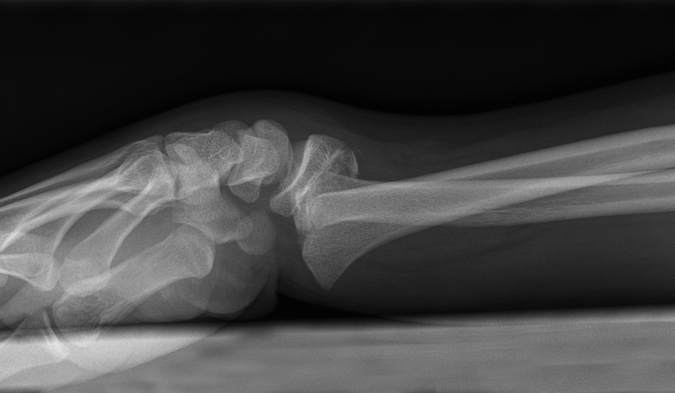 Salter II Fracture Distal Radius Lateral View (Hover over right edge to see more images)