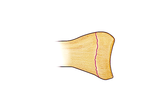 Salter I Fracture - Fracture line through growth plate (physis) but non displaced (Hover over right edge to see more images)