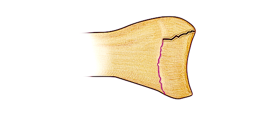 Salter III Fracture - Fracture line through growth plate (physis) and the epiphysis and articular surface. 