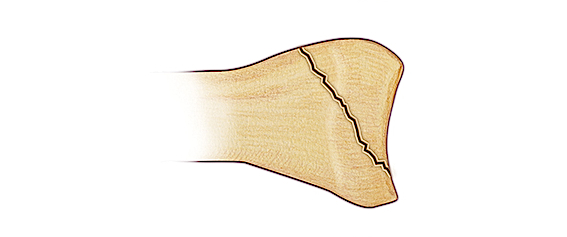 Salter IV Fracture - A vertical fracture line through metaphysis, the growth plate (physis) and the epiphysis and articular surface. 