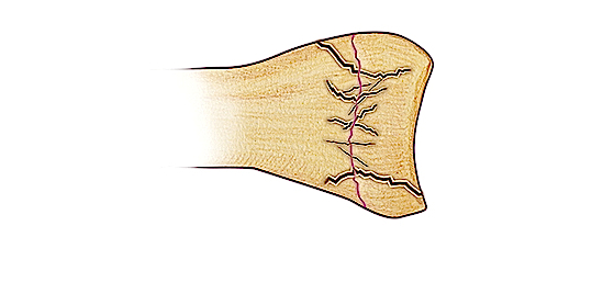 Salter V Fracture - A compression-type fracture line in the physis with extension in multiple directions. Growth plate (physis) damage is likely.