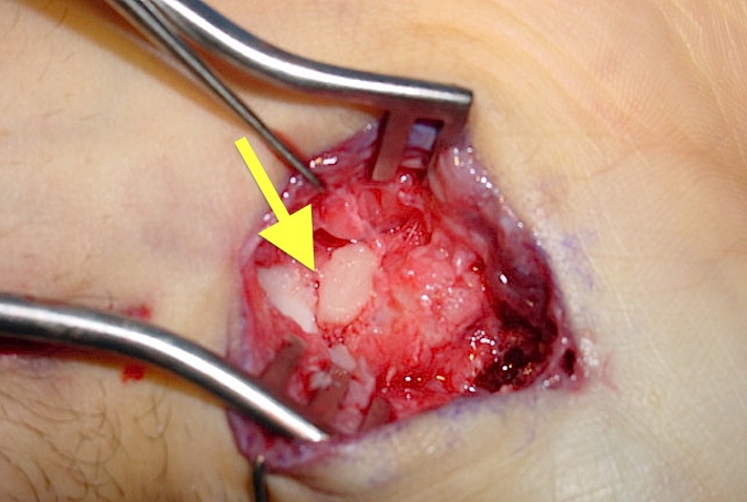 Scaphoid Fracture with arrow on fracture line (Hover over right edge to see more images)