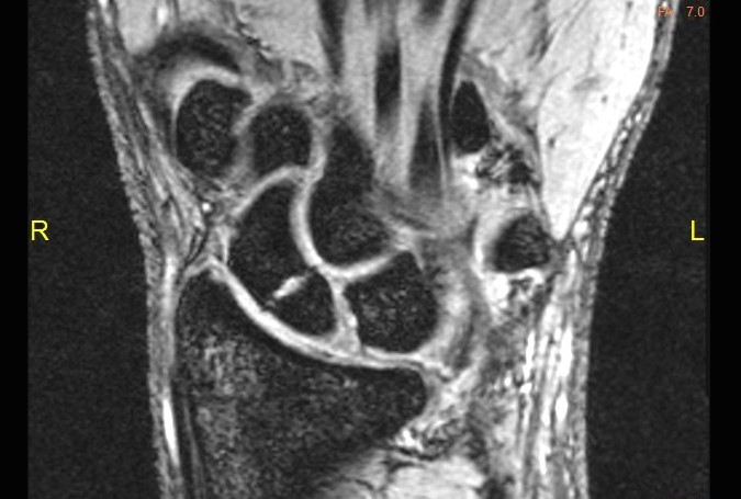 Scaphoid (Navicular) Fracture MRI  T1 showing fracture and no AVN