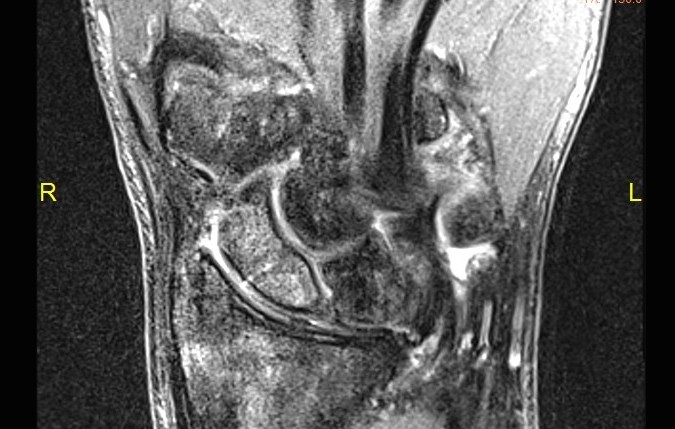 Scaphoid (Navicular) Fracture MRI  T2 showing marrow edema and fracture with no sign of AVN