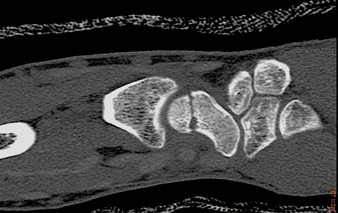 Scaphoid (Navicular) Fracture CT showing no healing of fracture