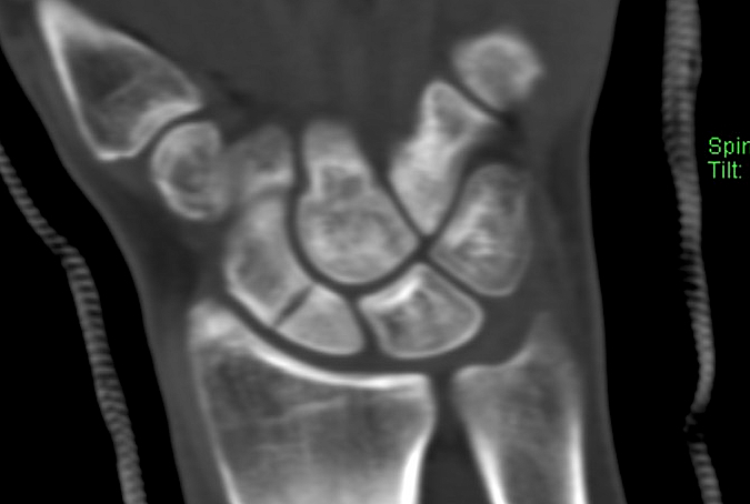 Scaphoid (Navicular) Fracture castedwithout healing