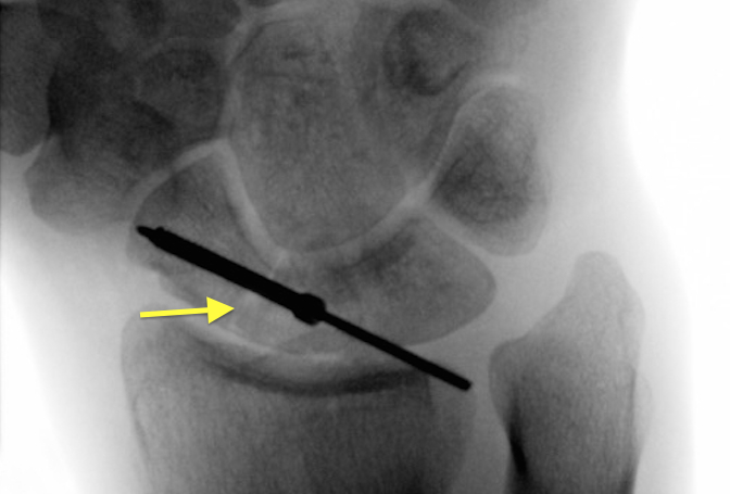 Scaphoid (Navicular) Fracture (arrow) undergoing internal fixation with screw