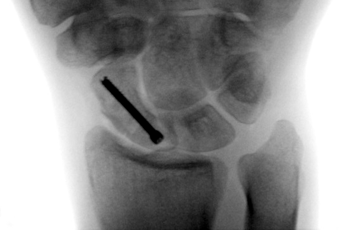 Scaphoid (Navicular) Fracture internally fixated with screw