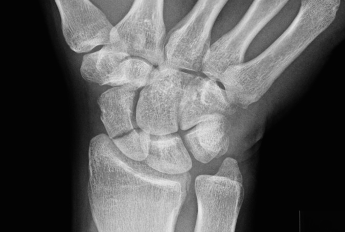 Non-displaced scaphoid fracture mid 1/3 proximal 1/3 junction (Hover over right edge to see more images)