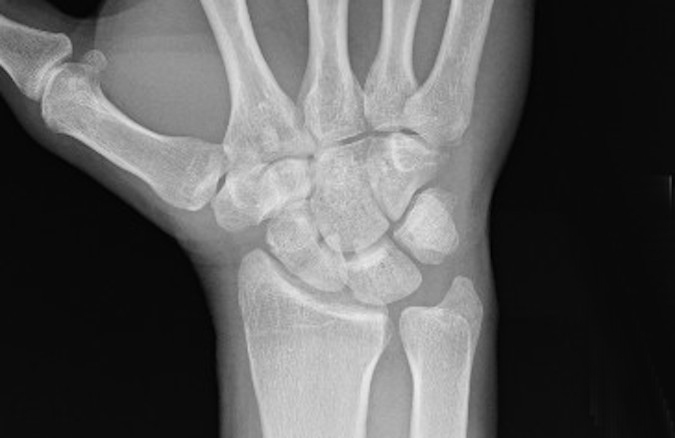 Non-displaced scaphoid fracture but not visible on this oblique view