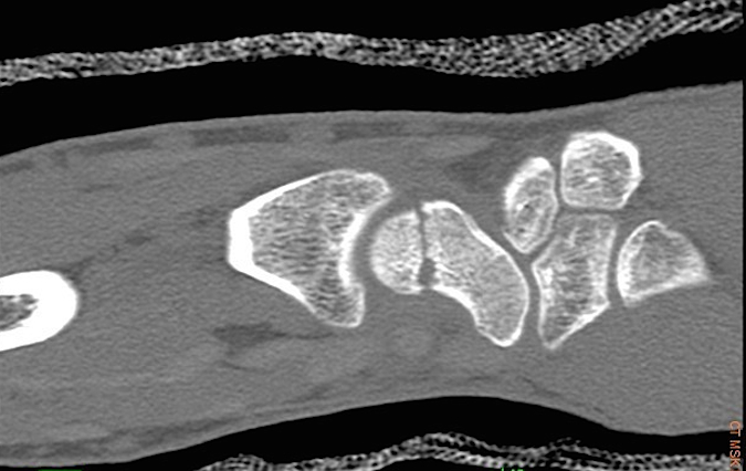 Non-displaced scaphoid fracture on CT with no bridging callus