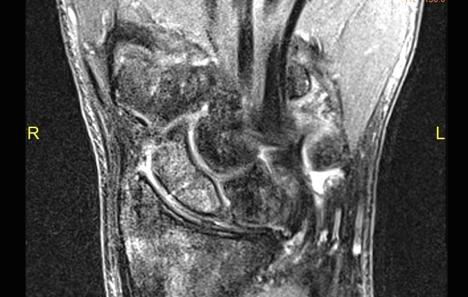 Non-displaced scaphoid fracture on MRI with no signs of AVN