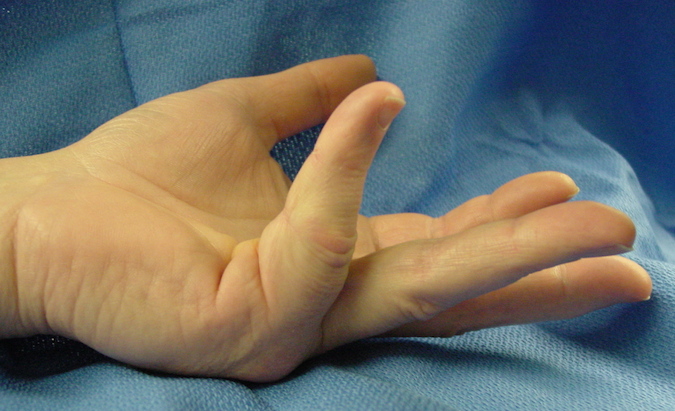 Dupuytren's Contracture fifth finger caused by classic central cord AP view