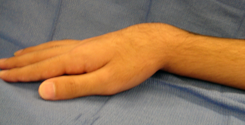 Silver Fork Deformity from Salter II Distal Radius Fracture