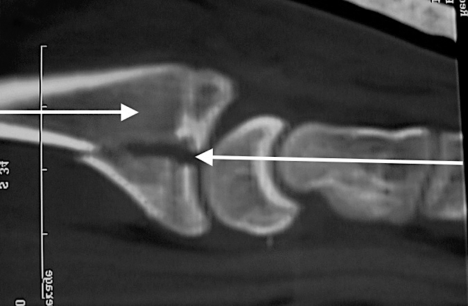 Intra-articular partially dislocated distal radius fracture which requires ORIF