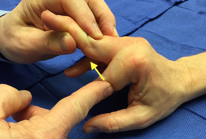 Stress testing index MP joint radial collateral ligament . MP in flexion to keep collateral tight while ulnar deviation force applied.