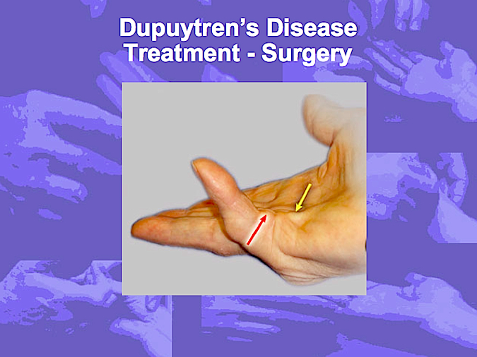 Surgical treatment of Dupuytren's Disease (Hover over right edge to see more images)