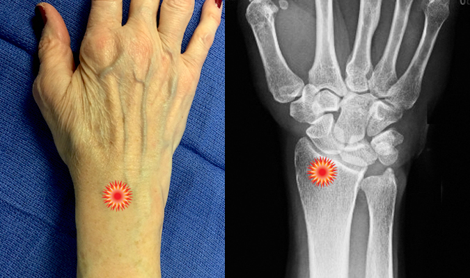 The red "tender"  sign pin points the area of tenderness in relationship to the carpal bones, distal radius  and the dorsal wrist surface anatomy of a patient with  a potential Colles' Fracture.