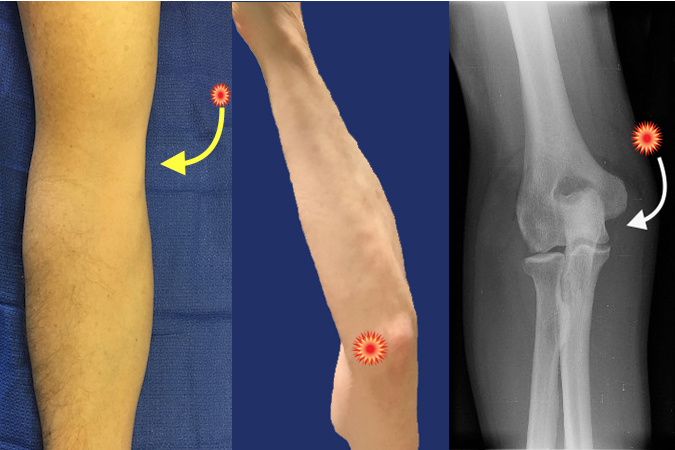 The tender point( red sign) associated with Cubital Tunnel syndrome and its Tinel sign is located behind the medial epicondyle in the olecranon groove.