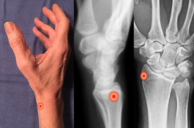 The red "tender"  sign pin points the area of tenderness in relationship to the lateral distal radius, AP distal radius and the radial wrist surface anatomy of a patient with  DeQuervain's Tenosynovitis.