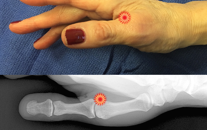 The red "tender"  sign pin points the area of tenderness in relationship to the metacarpal, proximal phalanx, MP joint and the surface anatomy of a patient with a Gamekeeper's  thumb injury.