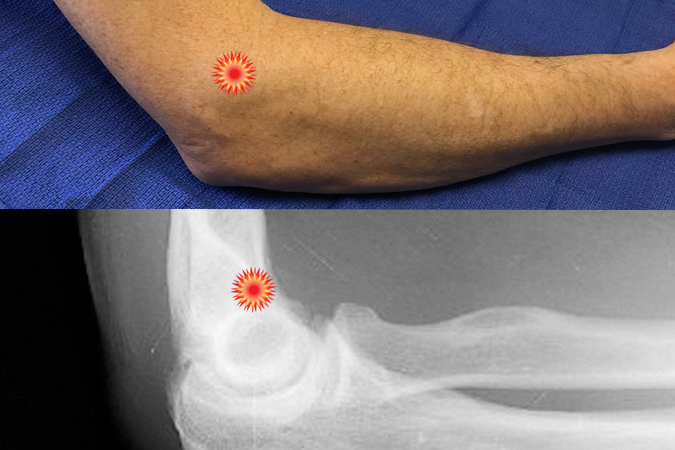 The red "tender"  sign pin points the area of tenderness in relationship to the lateral epicondyle and the lateral elbow surface anatomy of a patient with a lateral epicondylitis (Tennis Elbow).