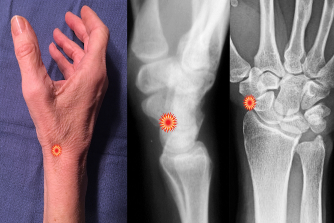 The red "tender"  sign pin points the area of tenderness in relationship to the lateral distal radius, AP distal radius and the radial wrist surface anatomy of a patient with a Scaphoid Fracture.