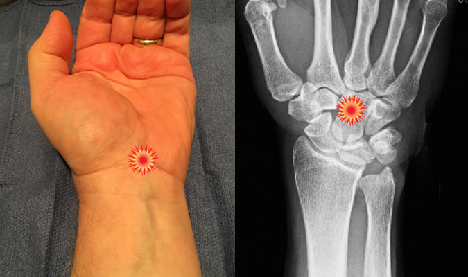 The red "tender"  sign pin points the area of tenderness in relationship to the carpal bones  and the volar wrist surface anatomy of a patient with  Carpal Tunnel Syndrome.