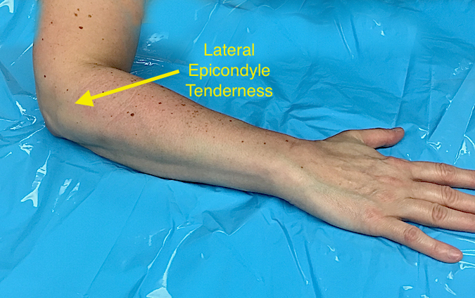 Lateral Epicondylitis (Tennis Elbow) (Hover over right edge to see more images)