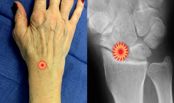 The red "tender"  sign pin points the area of tenderness in relationship to the distal radius, scaphoid,S-L joint  and the dorsal wrist surface anatomy of a patient with  a SLAC Wrist.