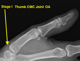 Thumb CMC OA Stage I normal or possible widening of the joint from synovitis and/or joint effussion; joint contours intact