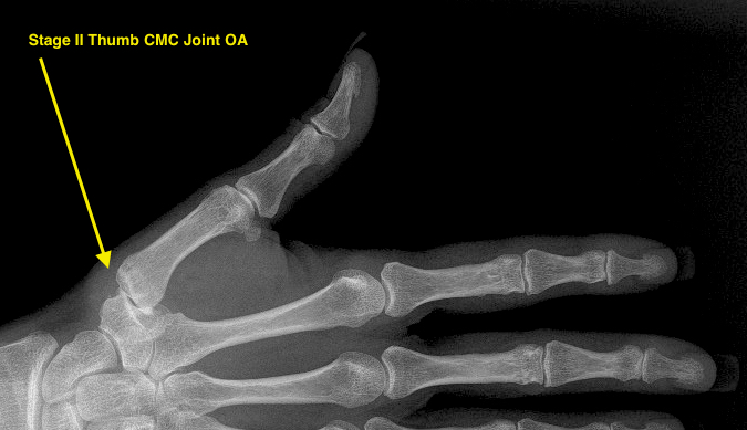 Thumb CMC (Basal Joint) OA Stage II narrow with debris and osteophytes less than 2 mm; minimal joint narrowing with only a few small erosions only; joint subluxed about one third of joint width