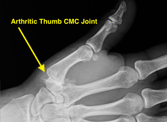 Thumb CMC OA Stage III narrow with debris and osteophytes greater than 2 mm; early joint narrowing with thumb cmc joint subluxed more than a third of the joint width