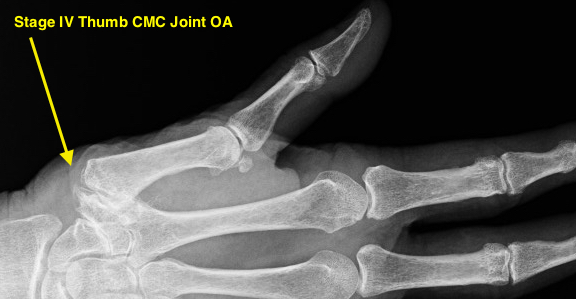 Thumb CMC OA Stage IV severe thumb cmc joint involvement plus scaphotrapezial joint degenerative changes; large osteophytes; possible loose bodies