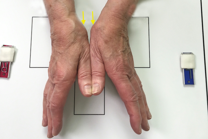 Positioning of thumbs for CMC joint (arrows) stress X-ray