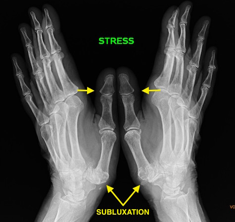 Thumb CMC joint stress X-ray with patient pushing tips of thumbs together forcing the thumb CMC joints to sublet maximally.