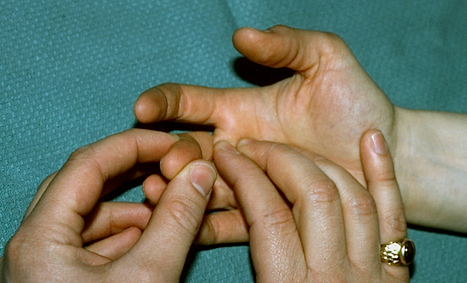 Right Long Trigger Finger Exam