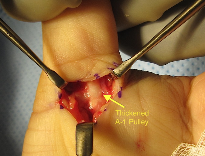 Trigger Thumb Thickened A-1 pulley