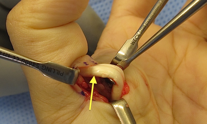 Trigger Thumb - Arrow separates "nota's"section proximally from normal FPL distal to A-1 constriction.