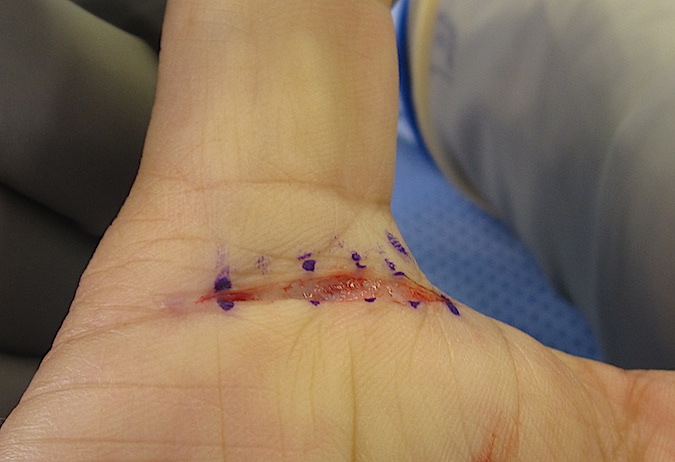 Trigger Thumb Incision (Hover over right edge to see more images)