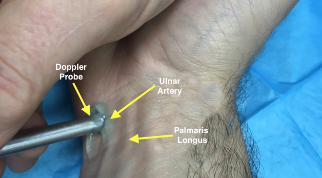 Doppler Assessing Ulnar Artery Pulse