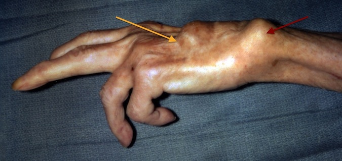 Caput Ulna Syndrome (Vaughan-Jackson Syndrome); Red arrow - Dorsal dislocated distal ulna; Orange Arrow - Distal ends of ruptured extensor tendons and rheumatoid dorsal tensynovitis.