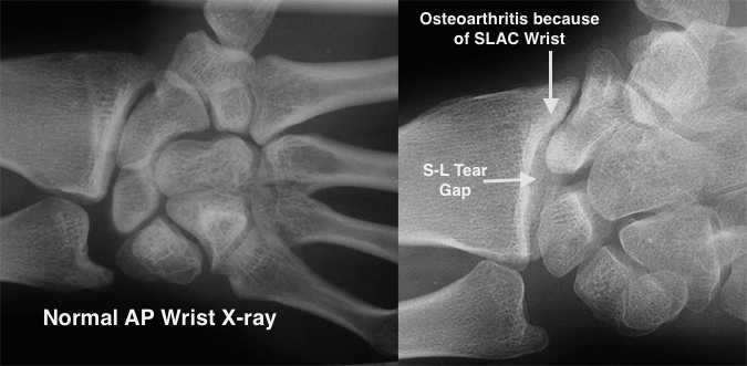 Normal wrist and arthritic wrist (Hover over right edge to see more images)