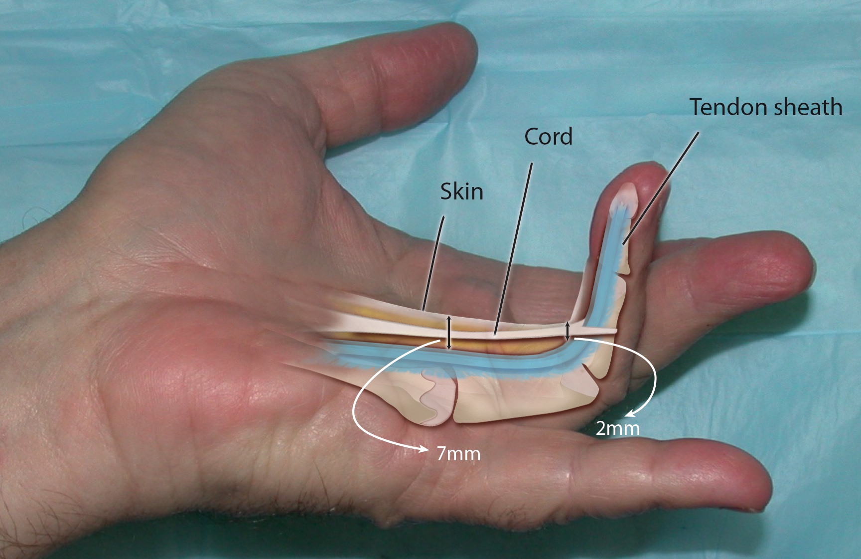 A Dupuyten's central cord displaced pal marly and "bowstrung" away from the flexor tendon sheath. Average distance from skin to sheath in the palm is 7mm and at the PIP level this distance is 4mm's.