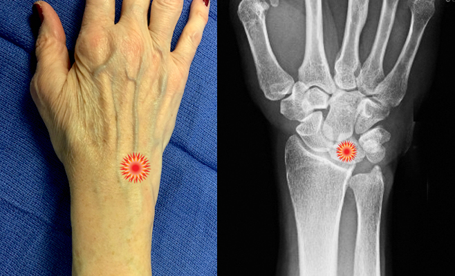 The red "tender"  sign pin points the area of tenderness in relationship to the distal ulna, distal radius  and the dorsal wrist surface anatomy of a patient with  a Kienbock's Disease.